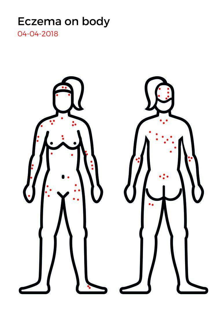 Eczema mapping-07.jpg