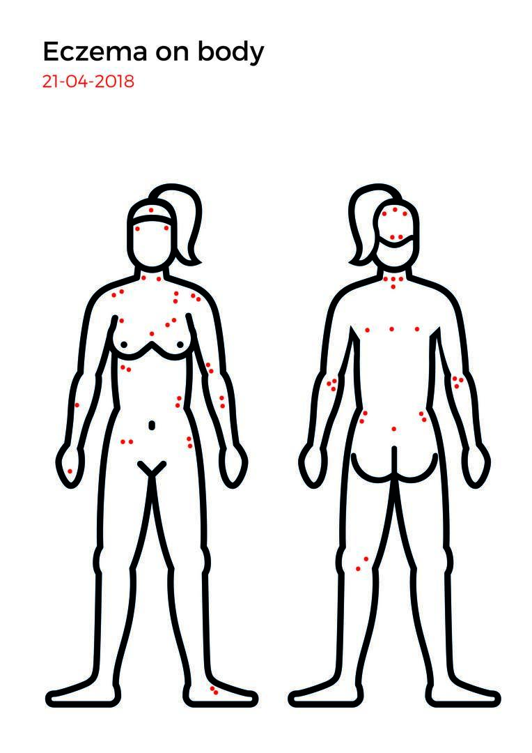 Eczema mapping-09.jpg