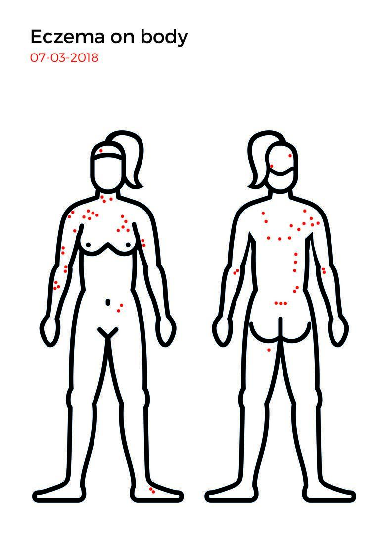 Eczema mapping-03.jpg