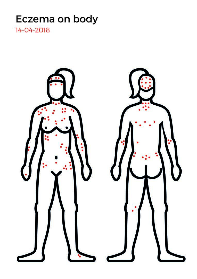 Eczema mapping-08.jpg