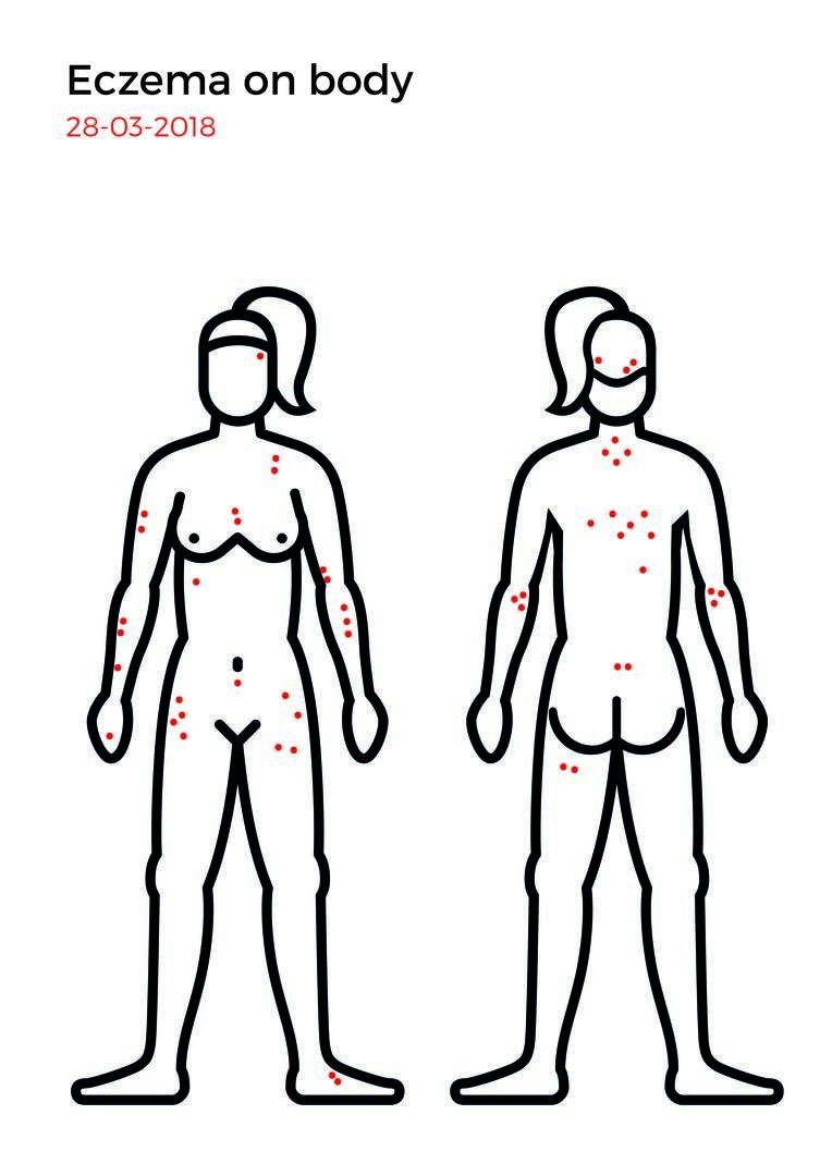Eczema mapping-06.jpg