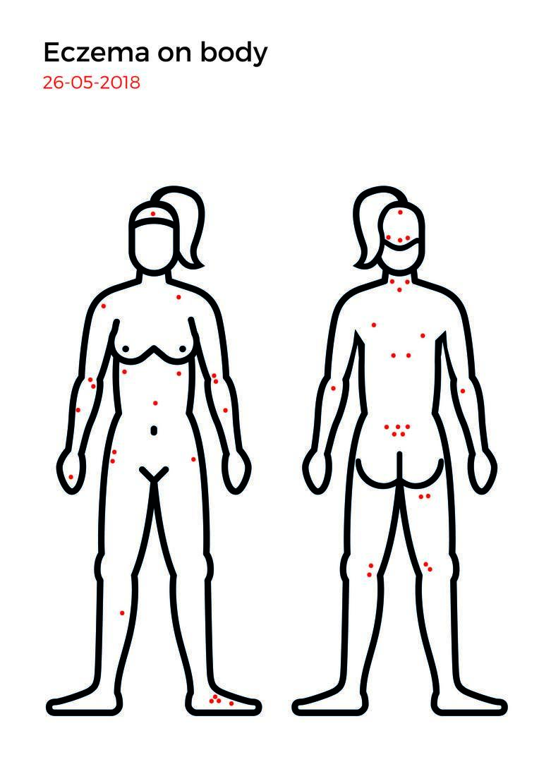 Eczema mapping-14.jpg