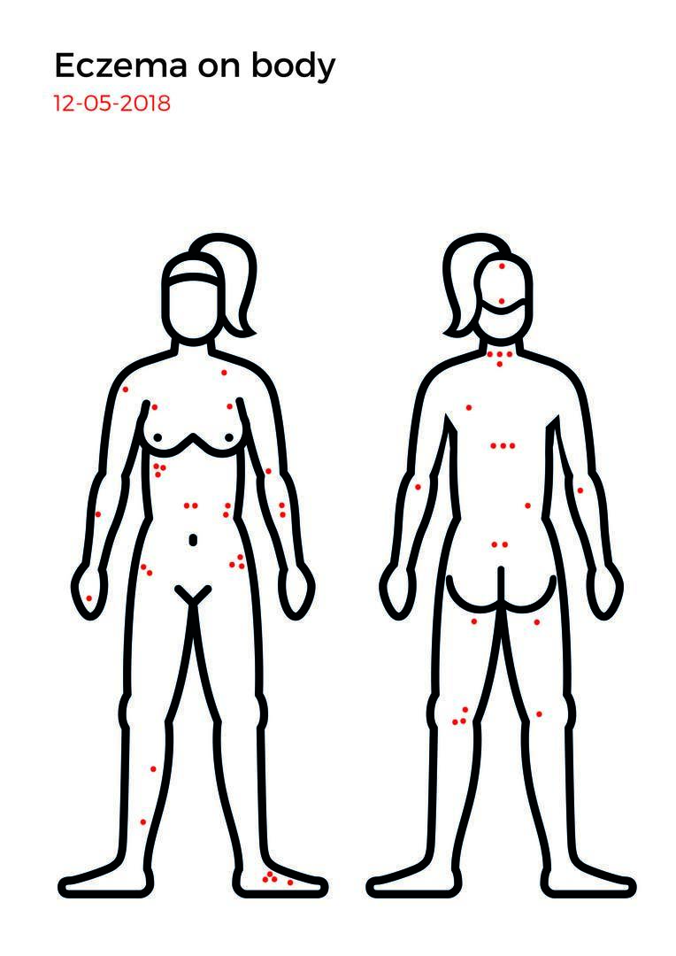 Eczema mapping-12.jpg