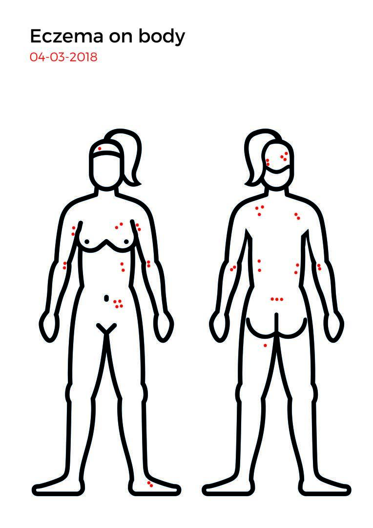 Eczema mapping-02.jpg