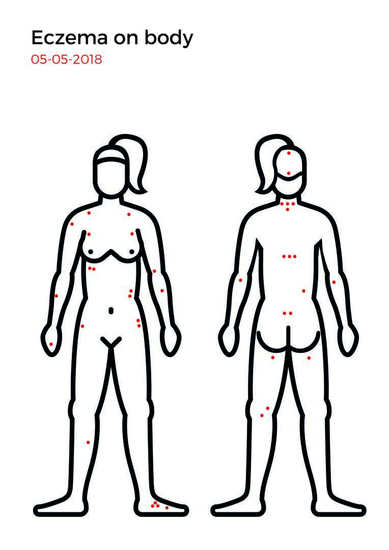 Eczema mapping-11.jpg