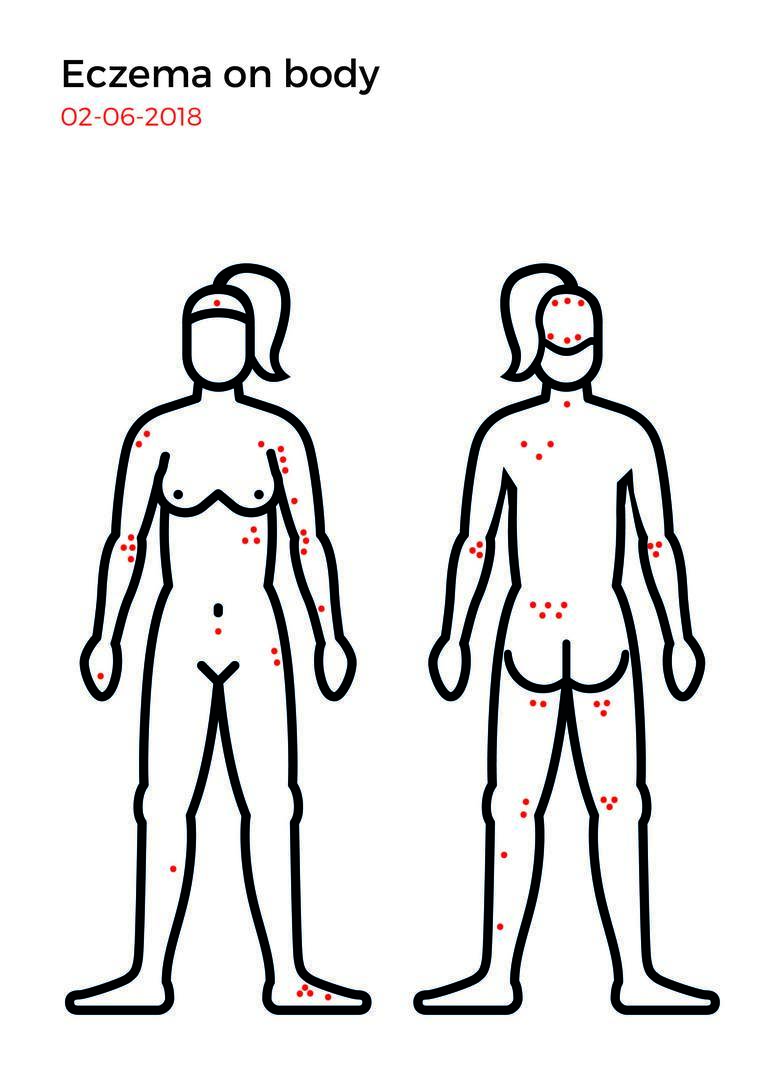 Eczema mapping-15.jpg
