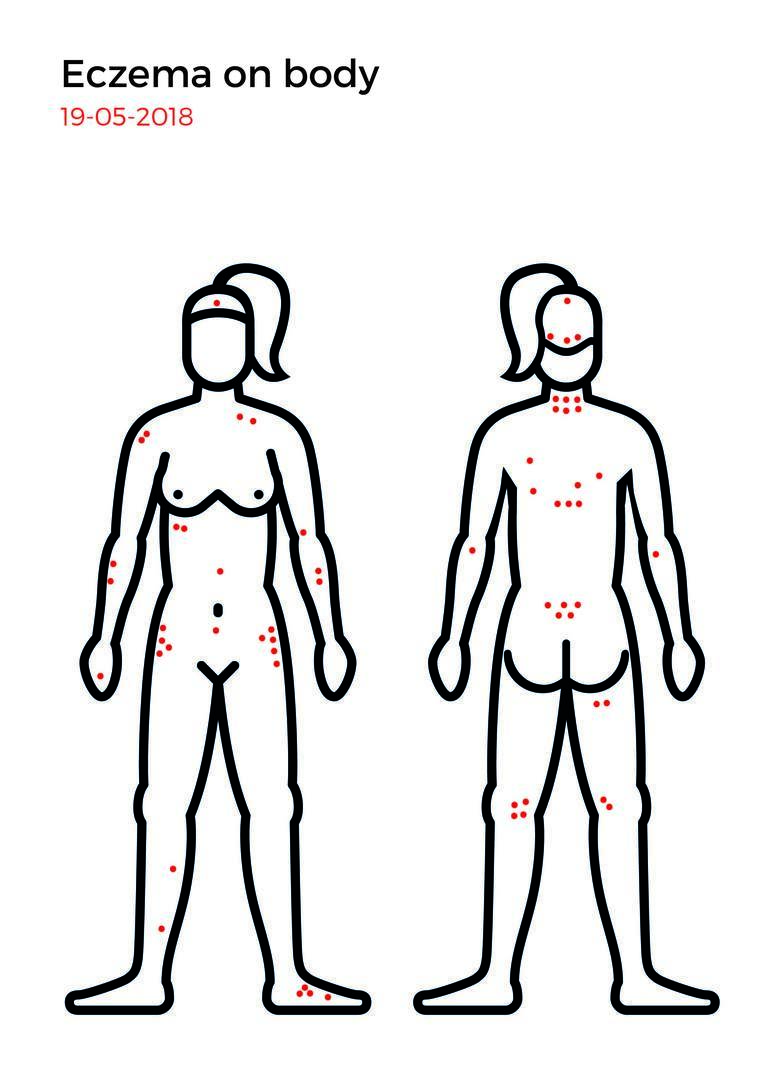 Eczema mapping-13.jpg
