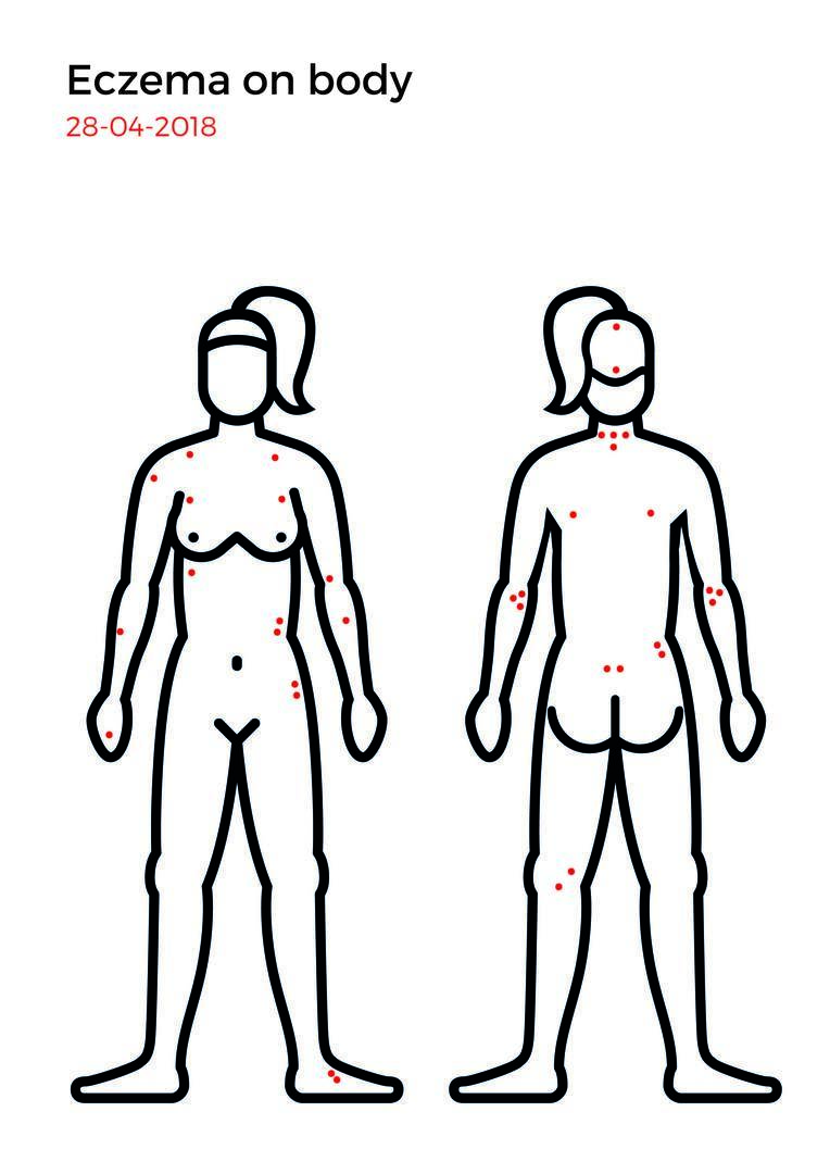 Eczema mapping-10.jpg